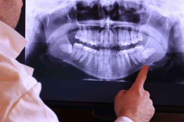 Best Emergency Dental Extractions in Wellington, OH