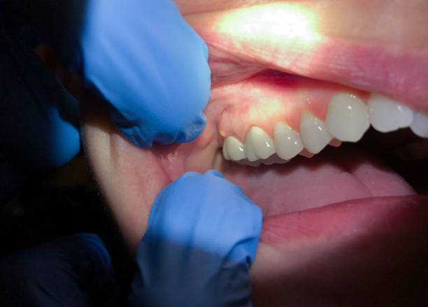 Best Broken or Cracked Tooth Emergency Dentist in Wellington, OH